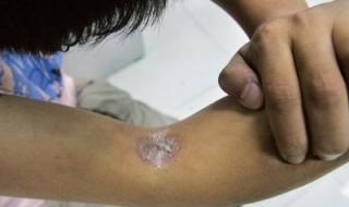 隐翅虫皮炎 隐翅虫皮炎